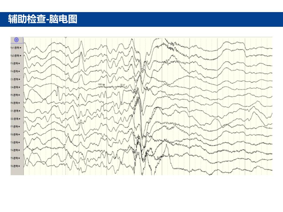 结节硬化症合并婴儿痉挛症1例